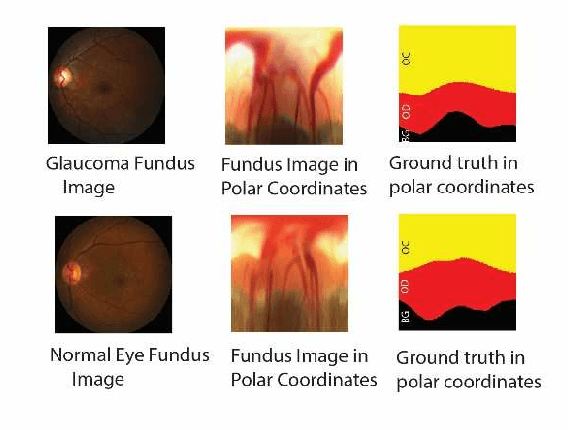 Figure 2 for M-Net with Bidirectional ConvLSTM for Cup and Disc Segmentation in Fundus Images