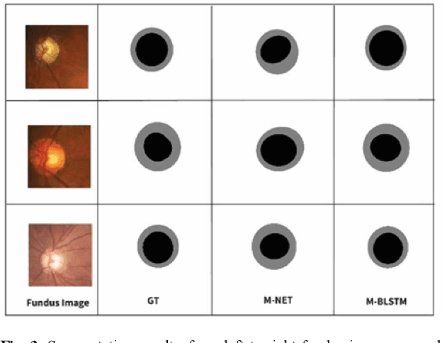 Figure 3 for M-Net with Bidirectional ConvLSTM for Cup and Disc Segmentation in Fundus Images