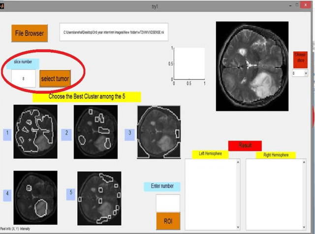 Figure 3 for Automated Tumor Segmentation and Brain Mapping for the Tumor Area