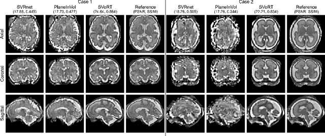 Figure 3 for SVoRT: Iterative Transformer for Slice-to-Volume Registration in Fetal Brain MRI