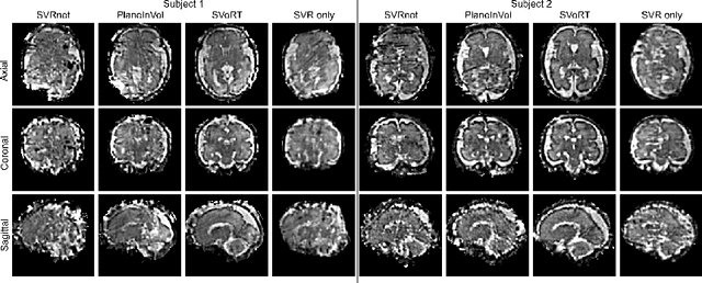 Figure 4 for SVoRT: Iterative Transformer for Slice-to-Volume Registration in Fetal Brain MRI