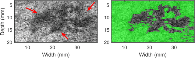 Figure 2 for Robust Scatterer Number Density Segmentation of Ultrasound Images