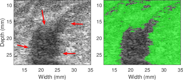 Figure 3 for Robust Scatterer Number Density Segmentation of Ultrasound Images