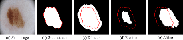 Figure 2 for Superpixel-guided Iterative Learning from Noisy Labels for Medical Image Segmentation