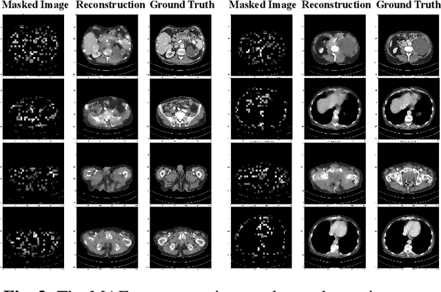 Figure 4 for Masked Autoencoders for Low dose CT denoising