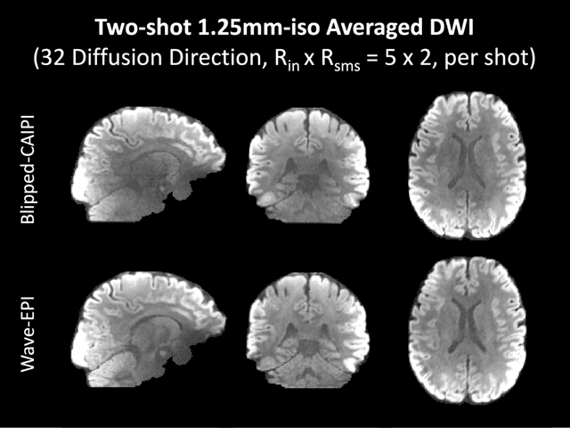 Figure 4 for Highly Accelerated EPI with Wave Encoding and Multi-shot Simultaneous Multi-Slice Imaging