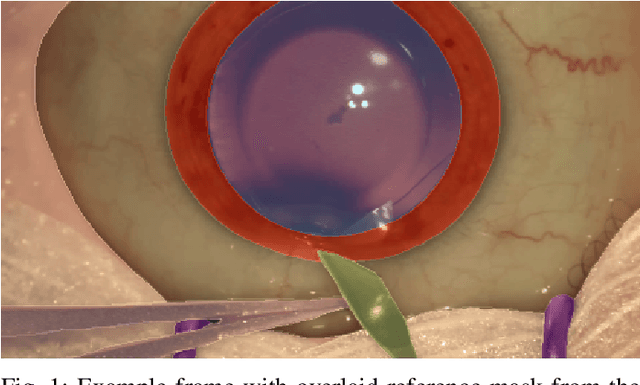 Figure 1 for 2020 CATARACTS Semantic Segmentation Challenge