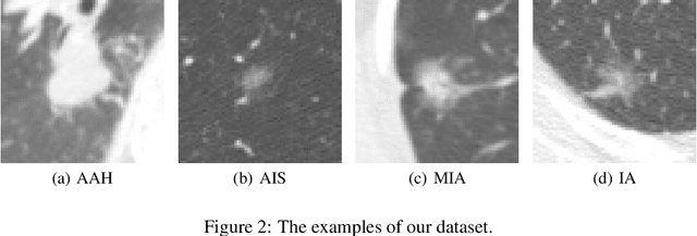 Figure 2 for Invasiveness Prediction of Pulmonary Adenocarcinomas Using Deep Feature Fusion Networks