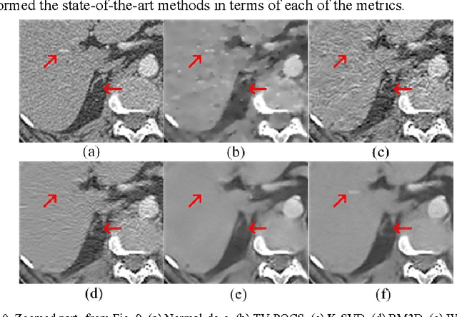 Figure 1 for Low-Dose CT with a Residual Encoder-Decoder Convolutional Neural Network (RED-CNN)