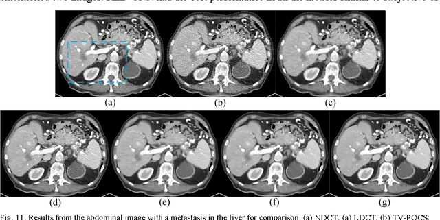 Figure 2 for Low-Dose CT with a Residual Encoder-Decoder Convolutional Neural Network (RED-CNN)