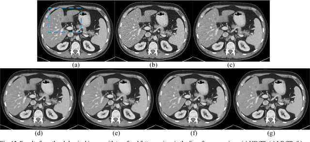 Figure 4 for Low-Dose CT with a Residual Encoder-Decoder Convolutional Neural Network (RED-CNN)