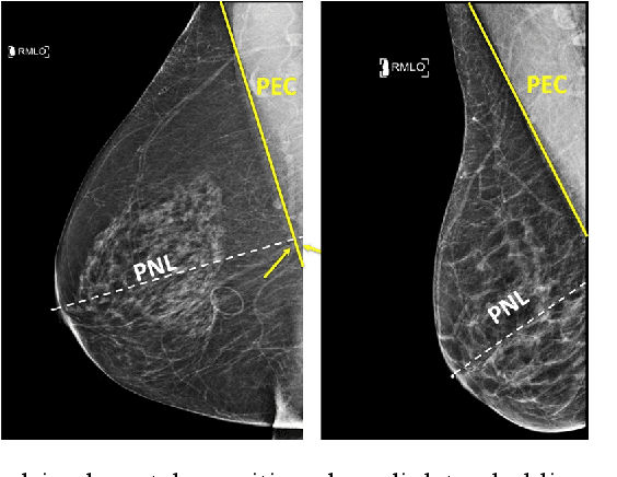 Figure 1 for Deep Learning-Based Automatic Detection of Poorly Positioned Mammograms to Minimize Patient Return Visits for Repeat Imaging: A Real-World Application