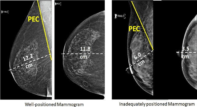 Figure 2 for Deep Learning-Based Automatic Detection of Poorly Positioned Mammograms to Minimize Patient Return Visits for Repeat Imaging: A Real-World Application