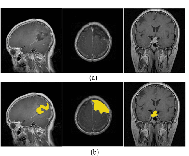 Figure 1 for Brain Tumor Segmentation by Cascaded Deep Neural Networks Using Multiple Image Scales