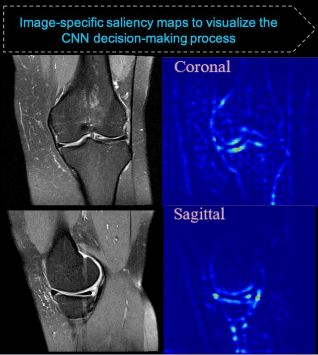 Figure 2 for Improved Diagnosis of Tibiofemoral Cartilage Defects on MRI Images Using Deep Learning