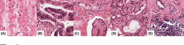 Figure 1 for Autonomous Extraction of Gleason Patterns for Grading Prostate Cancer using Multi-Gigapixel Whole Slide Images