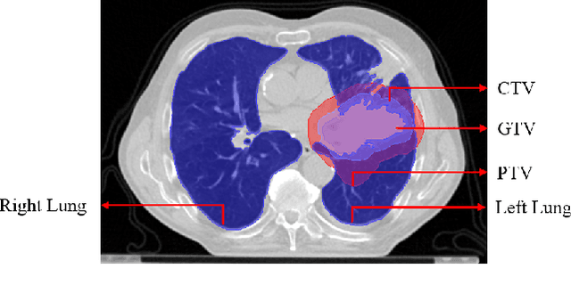 Figure 1 for Lung-Originated Tumor Segmentation from Computed Tomography Scan (LOTUS) Benchmark