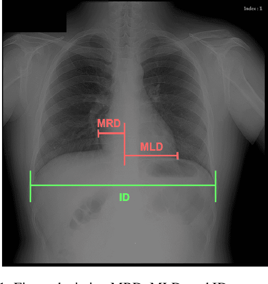 Figure 1 for Automated Cardiothoracic Ratio Calculation and Cardiomegaly Detection using Deep Learning Approach