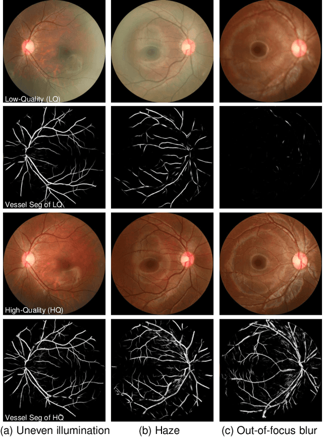 Figure 3 for RFormer: Transformer-based Generative Adversarial Network for Real Fundus Image Restoration on A New Clinical Benchmark