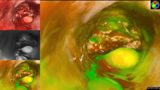 Figure 1 for Perfusion Quantification from Endoscopic Videos: Learning to Read Tumor Signatures