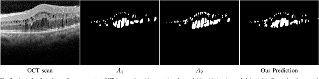 Figure 2 for Segmentation of Macular Edema Datasets with Small Residual 3D U-Net Architectures