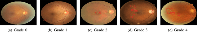 Figure 1 for Multi-Cell Multi-Task Convolutional Neural Networks for Diabetic Retinopathy Grading