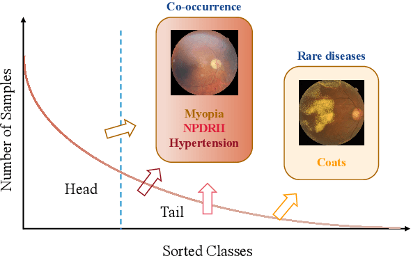 Figure 1 for Long-Tailed Multi-Label Retinal Diseases Recognition Using Hierarchical Information and Hybrid Knowledge Distillation