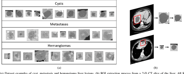 Figure 1 for GAN-based Synthetic Medical Image Augmentation for increased CNN Performance in Liver Lesion Classification
