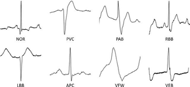 Figure 3 for ECG arrhythmia classification using a 2-D convolutional neural network