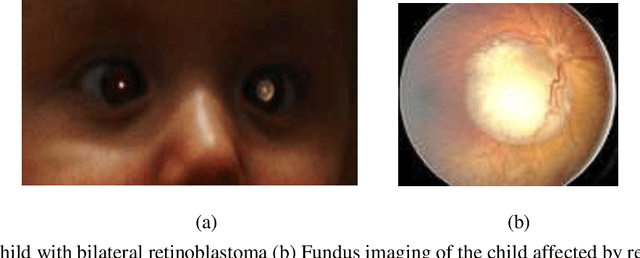 Figure 1 for Early Prediction and Diagnosis of Retinoblastoma Using Deep Learning Techniques