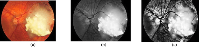 Figure 3 for Early Prediction and Diagnosis of Retinoblastoma Using Deep Learning Techniques