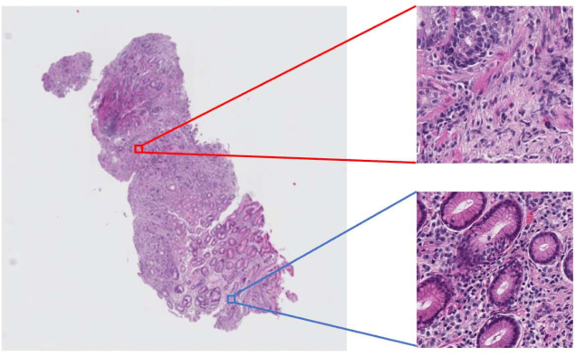 Figure 1 for Multi-Stage Pathological Image Classification using Semantic Segmentation