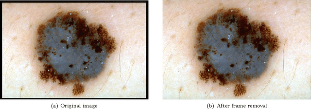 Figure 1 for Approximate Lesion Localization in Dermoscopy Images