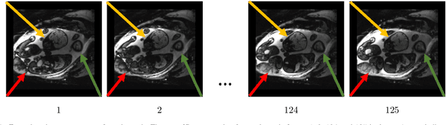 Figure 1 for Temporal Registration in Application to In-utero MRI Time Series