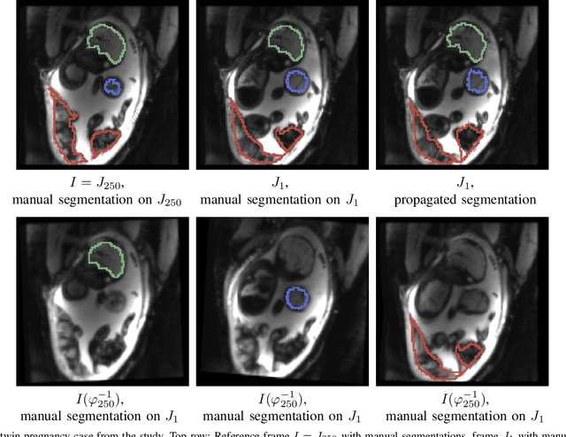 Figure 3 for Temporal Registration in Application to In-utero MRI Time Series