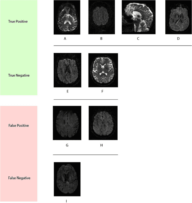 Figure 4 for 3D-QCNet -- A Pipeline for Automated Artifact Detection in Diffusion MRI images