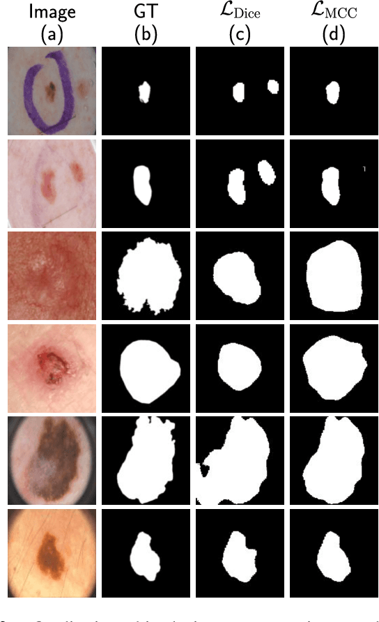 Figure 2 for Matthews Correlation Coefficient Loss for Deep Convolutional Networks: Application to Skin Lesion Segmentation