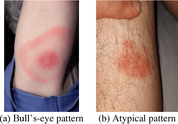 Figure 1 for Benchmarking convolutional neural networks for diagnosing Lyme disease from images