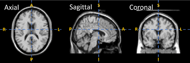 Figure 1 for A novel framework for automatic detection of Autism: A study on Corpus Callosum and Intracranial Brain Volume
