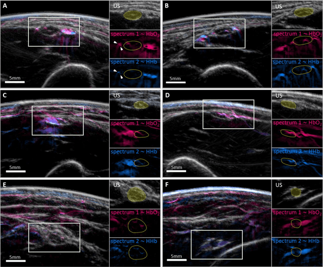 Figure 4 for Spotlight on nerves: Portable multispectral optoacoustic imaging of peripheral nerve vascularization and morphology