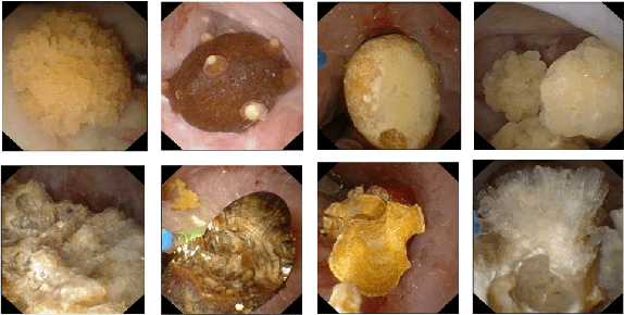 Figure 1 for Assessing deep learning methods for the identification of kidney stones in endoscopic images