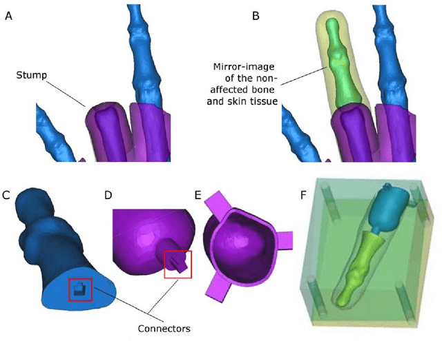 Figure 3 for Patient-Specific Prosthetic Fingers by Remote Collaboration - A Case Study