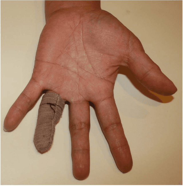 Figure 1 for Patient-Specific Prosthetic Fingers by Remote Collaboration - A Case Study
