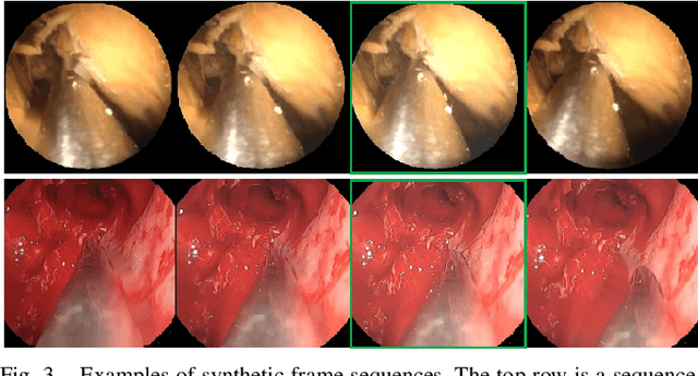 Figure 3 for Multi-frame Feature Aggregation for Real-time Instrument Segmentation in Endoscopic Video