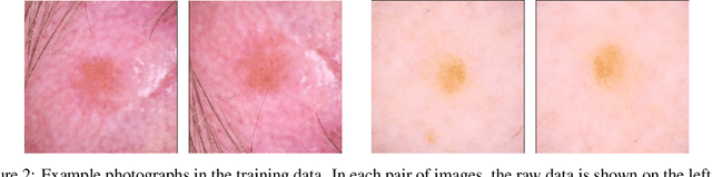 Figure 3 for Deep Transfer Learning for Automated Diagnosis of Skin Lesions from Photographs