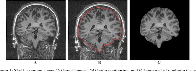 Figure 1 for Automatic and Manual Segmentation of Hippocampus in Epileptic Patients MRI
