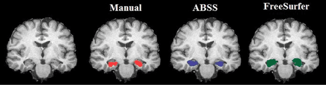 Figure 2 for Automatic and Manual Segmentation of Hippocampus in Epileptic Patients MRI