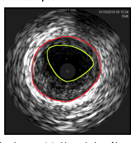 Figure 1 for A Deep Learning-based Method to Extract Lumen and Media-Adventitia in Intravascular Ultrasound Images