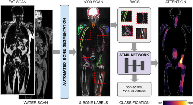 Figure 1 for Multiple Instance Learning with Auxiliary Task Weighting for Multiple Myeloma Classification