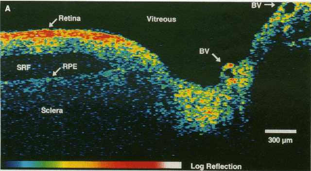 Figure 1 for State-of-the-Art in Retinal Optical Coherence Tomography Image Analysis